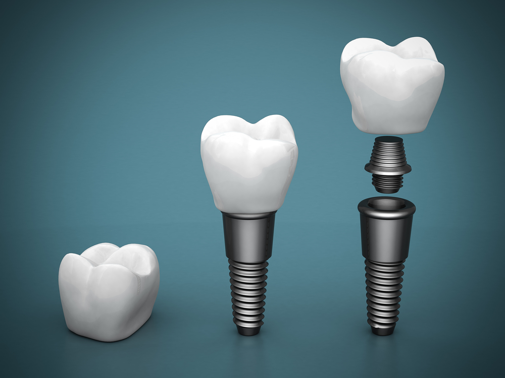 An Introduction to Dental Implants