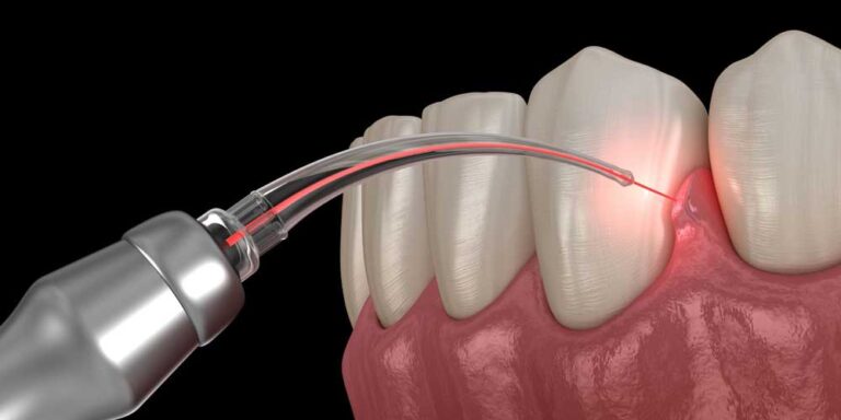 Gum Disease Laser Treatment