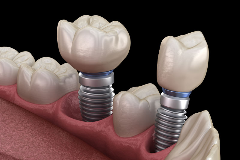 Dental Implant In Your Mouth