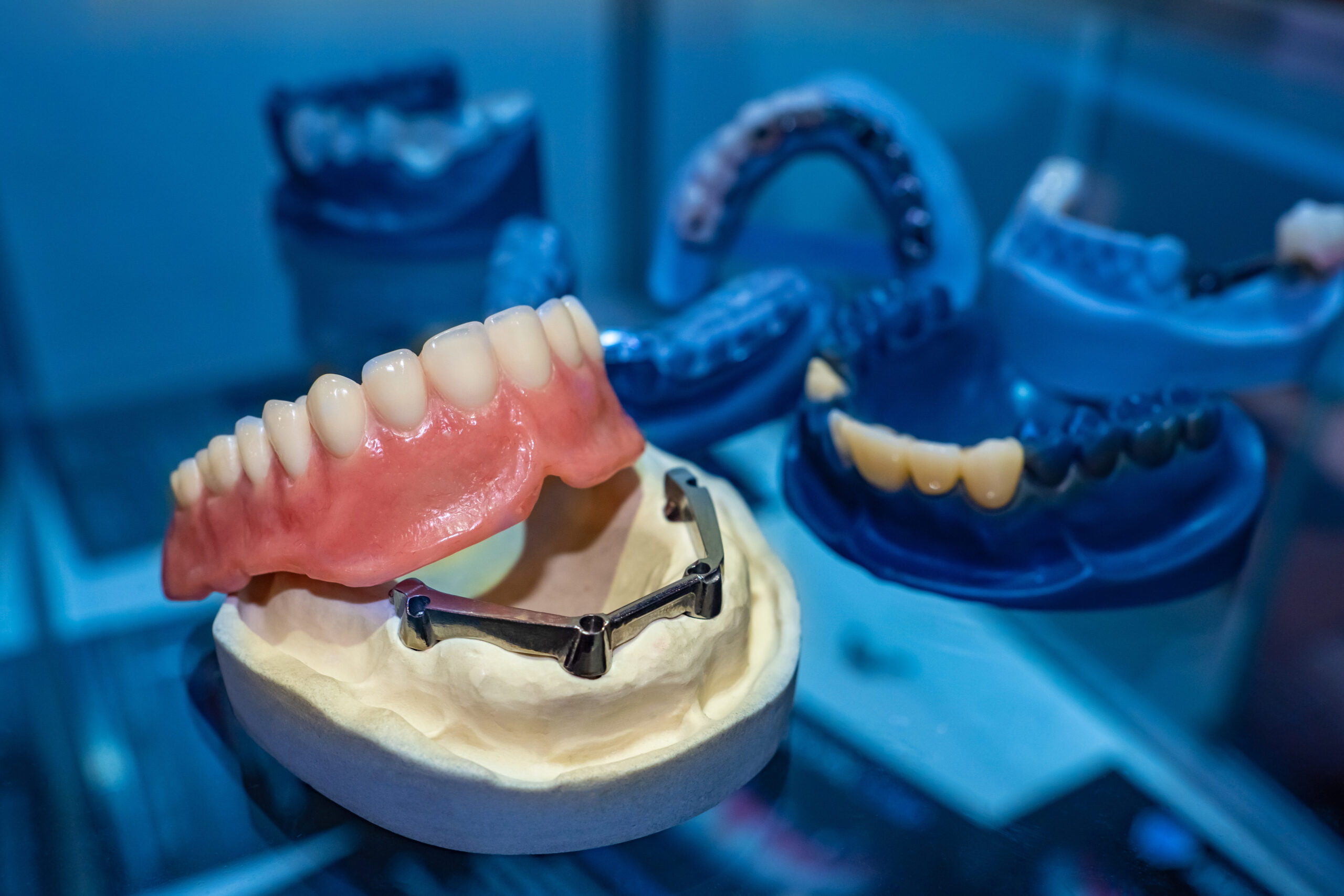 a full mouth dental prosthesis model of a lower arch on implants.