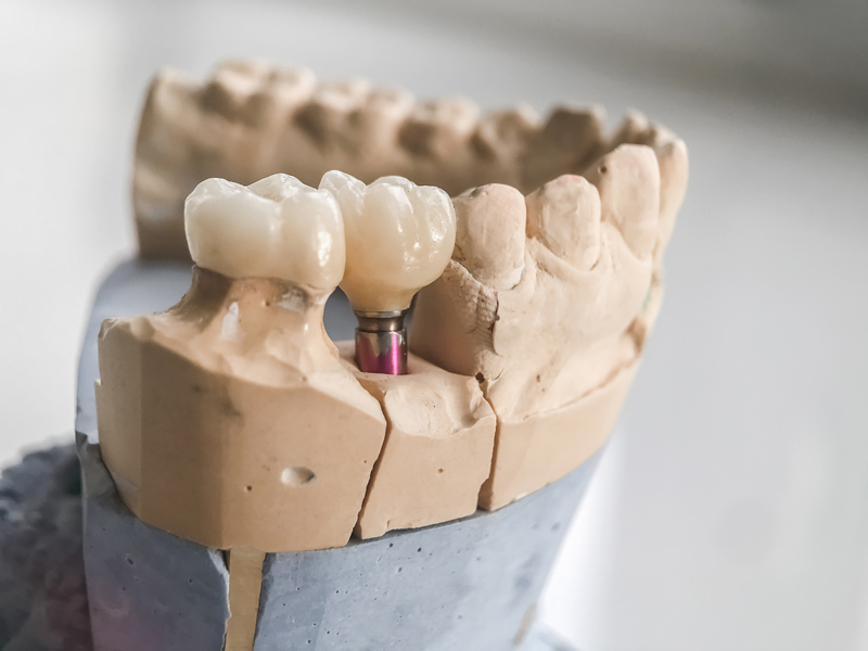 a full mouth dental implant model with exposed dental implant post.